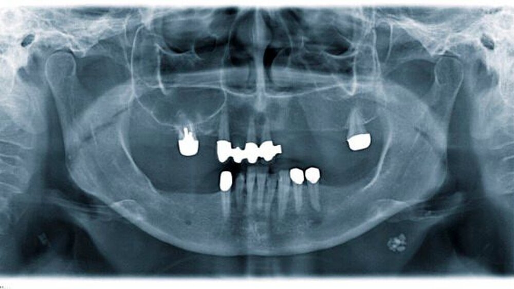 Abbildung 5: Speichelstein der Glandula submandibularis links |