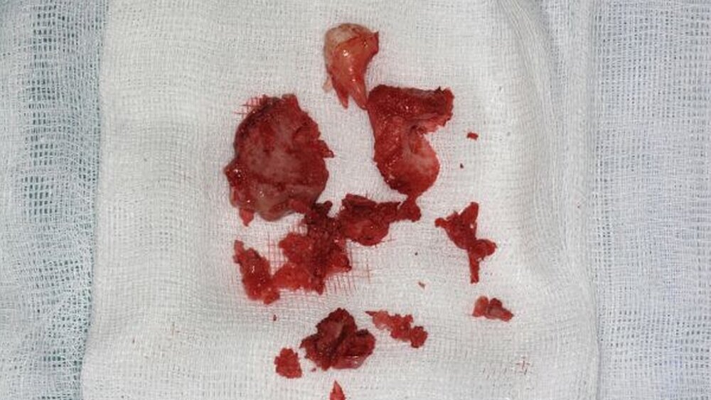 Abbildung 4: In Fragmente zerlegtes Osteom inklusive des retinierten und verlagerten Zahnes 18. |