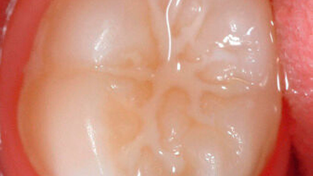 Eine intakte Fissurenvergiegelung am Zahn 46 |