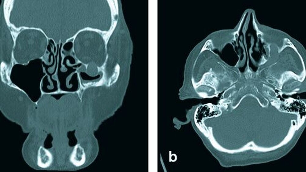 Abbildung 2: a coronar, b axial: Knochenfenster: Die Computertomografie zeigt einen bis zur Schädelbasis wachsenden Tumor mit Auftreibung des Canalis infraorbitalis. |