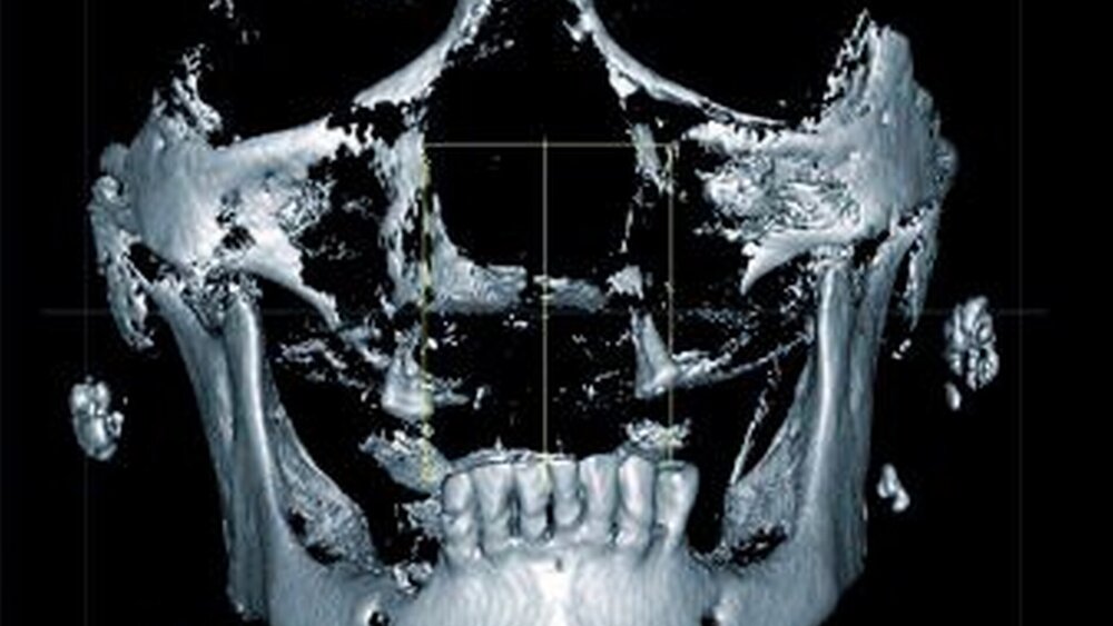 Abbildung 2: Die DVT zeigt die räumliche Verteilung der röntgenopaken Strukturen, die sich topografisch den Lymphknoten der Glandula parotis zuordnen lassen. |