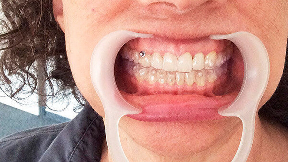 Abbildung 11: Die Patientin erhielt eine einjährige Intervallbehandlung nach IMT. Nach sechs Monaten erfolgte die Eingliederung von Invisalign-Schienen. |