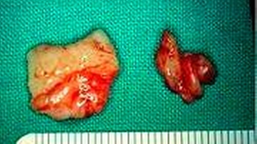 Abb. 3: Die Biopsie aus der lingualen Schleimhautverdickung zeigt ein derbes, klinisch narbig imponierendes Gewebe. Histologisch handelte es sich um Infiltrate eines hochmalignen B-Zell-Lymphoms.
