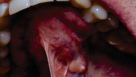 Ein Tumor in der Mundhöhle eines Erwachsenen