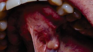 Ein Tumor in der Mundhöhle eines Erwachsenen