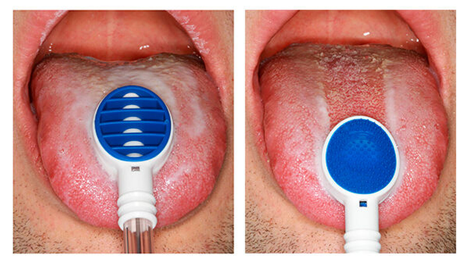 Halitosis (2): "Zungenreinigung ist kariesprotektiv" - zm-online