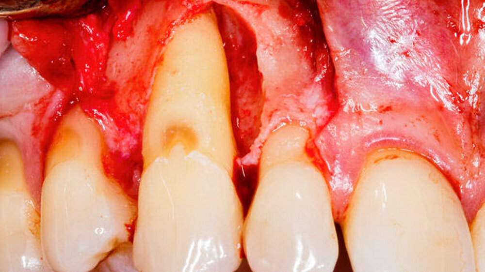 Klinische Aufnahme während eines parodontal-chirurgischen Eingriffs – gut ausgeleuchteter und möglichst blutfrei dargestellter intraoperativer Situs Klinische Aufnahme während eines parodontal-chirurgischen Eingriffs – gut ausgeleuchteter und möglichst blutfrei dargestellter intraoperativer Situs