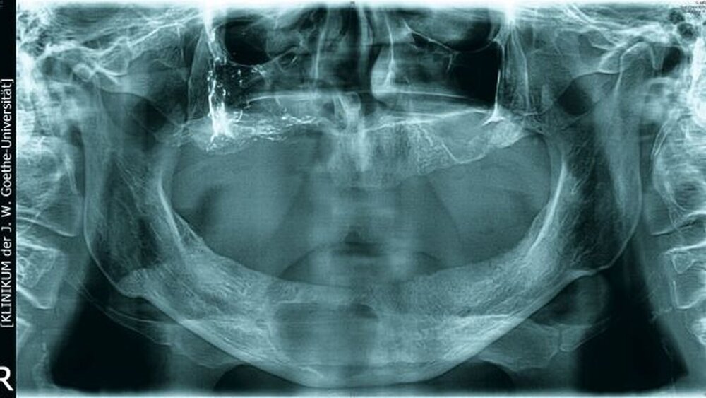 Abbildung 5: Postoperatives OPG nach Zahnextraktion: Zystektomie im UK und Dekortikation im OK: Die Opazität in der rechten Kieferhöhle entspricht den Residuen der eingelegten Jodoformtamponade. |