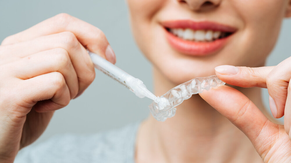 Eine junge Frau führt eine Zahnaufhellung mit einer Schiene und Gel zu Hause durch.