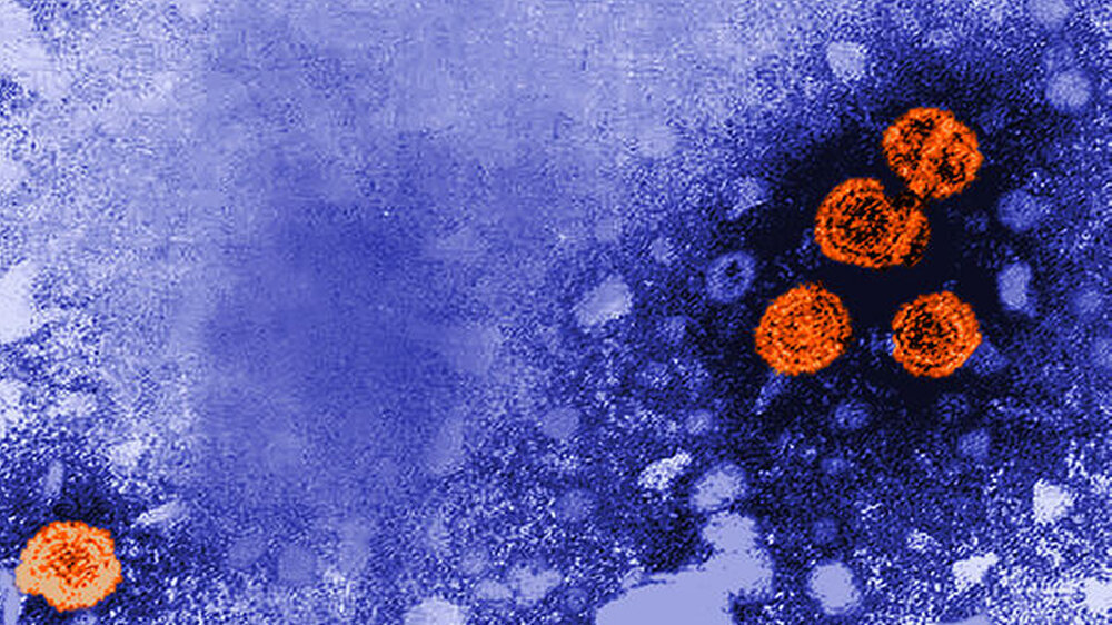 Hepatitis-B-Virionen im Elektronenmikroskop