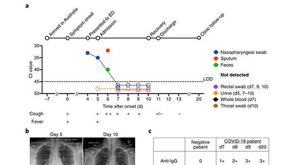Die Forscher dokumentierten die Immunabwehr der Covid-19-Patientin und zeigten, wie sich der Organismus gegen das Virus wehrt.