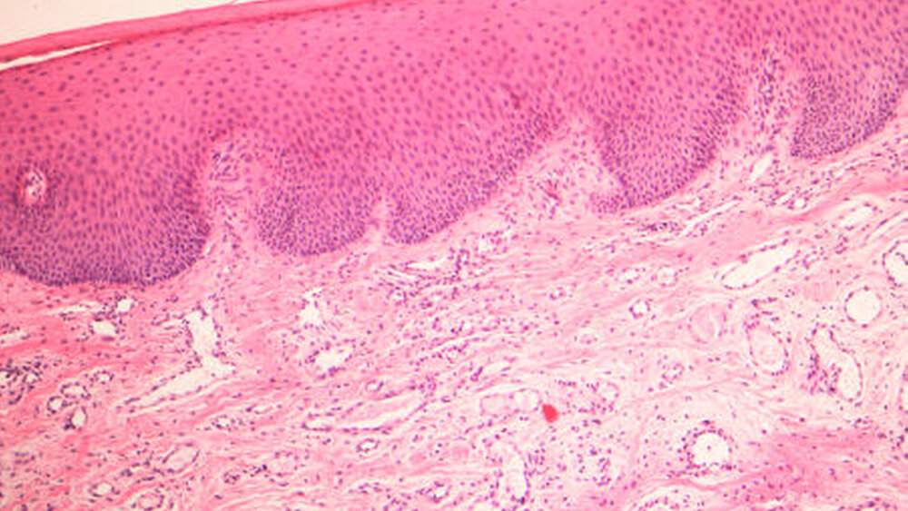 Abbildung 4: Histologie: Übersichtsaufnahme des marginalen Parodontiums am Zahn 25 |