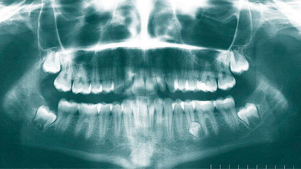Abbildung 7: Im Rahmen eine kieferorthopäsischen Therapie zufällig diagnostizierter überzähliger Prämolar (35+) im linken Unterkiefer bei einer 14,5-jährigen Patientin. Als weiterer relevanter Befund lassen sich Zahnkeime von Distomolaren im Unterkiefer beidseits (sogenannte „9er“) erkennen. |