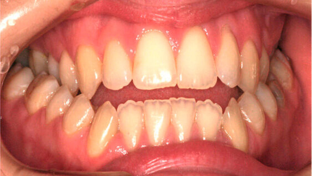 Abbildung 1: b) Der intraorale Befund von frontal zeigt den frontal offenen Biss und den zirkulären Kreuzbiss. |