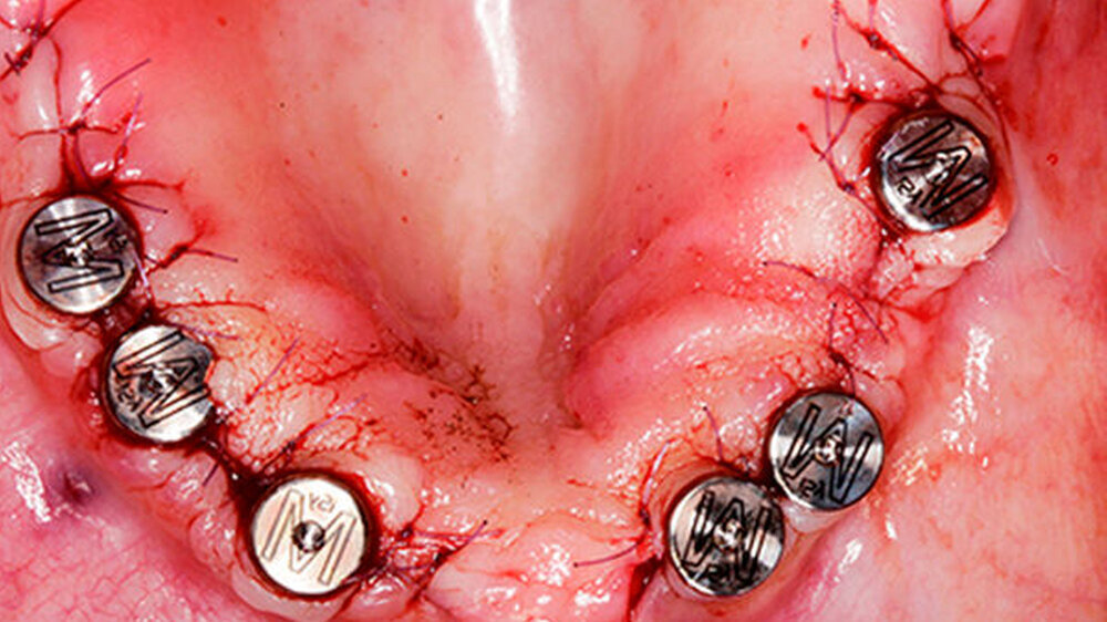 Gingivaformer