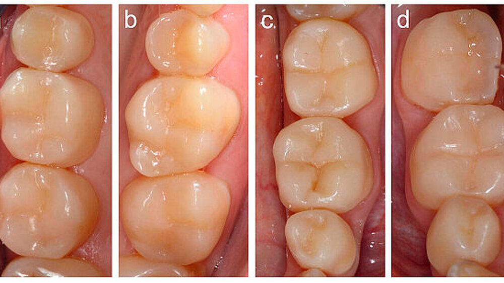 Abbildung 4: Fertiggestellte Komposit-Seitenzahnrestaurationen: a: 1. Quadrant, b: 2. Quadrant, c: 3. Quadrant, d: 4. Quadrant |