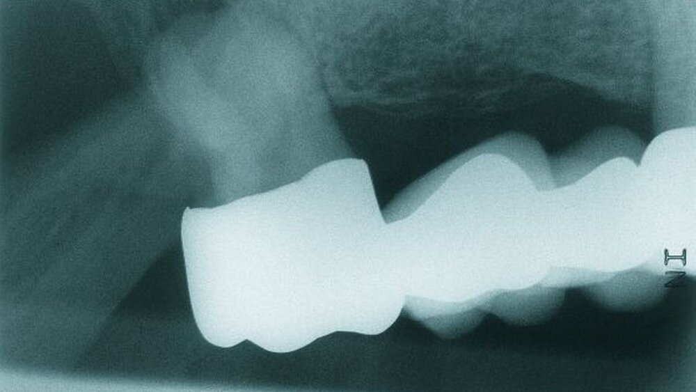 Abbildungen 3a, 3b: Zahnfilmaufnahmen der regiones 17 und 27 vom 29.04.2008. |