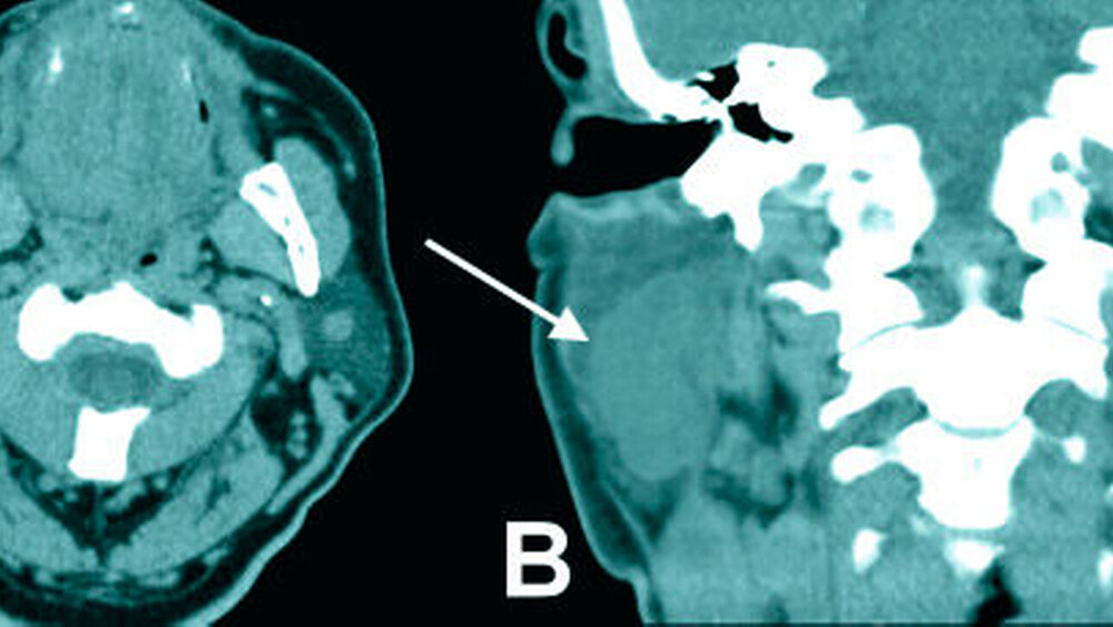 Abbildung 3: Präoperative Computertomografie. Es stellt sich eine scharf begrenzte, lobulierte Raumforderung (weiße Pfeile) von circa 5 cm x 3 cm x 2 cm Größe am unteren rechten Parotispol dar (A: axial; B: coronar). |