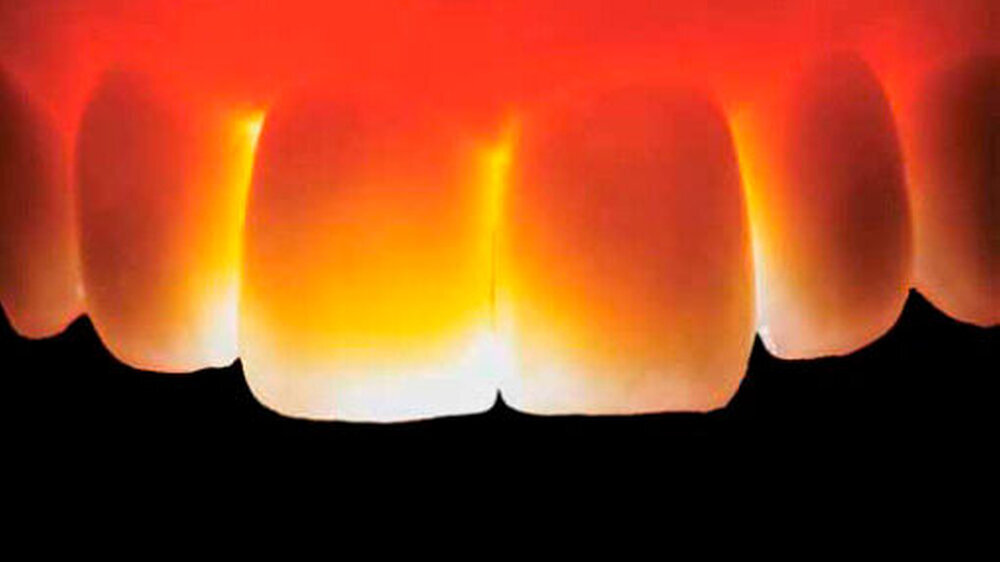 Brücke von 12 auf 21, hergestellt mit dem Zirkonoxidkeramik-System LAVA (3M ESPE). Die minimale Schichtdicke des Gerüsts beträgt 0,5 Millimeter, bei Einzelkronen werden mit dem nächsten Produkt-Update 0,3 Millimeter ausreichend sein.