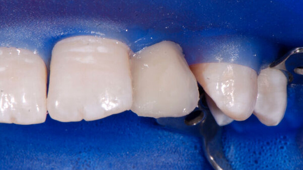 Abbildung 4: Dentinkern-Aufbau mit Ceram•X duo D1/D2