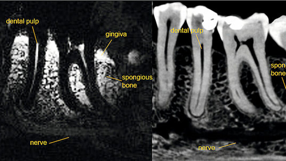 Sagittales Schnittbild in der MRT (links) und in der DVT (rechts) des Unterkieferpräparats:  Die Zahnpulpa, die Gingiva, der spongiöse Knochen und der N. alveolaris inferior sind im MRT dargestellt, während die DVT die knöcherne Begrenzung des Nervkanals, die Begrenzungen  der Pulpakammer und den kortikalen Knochen abbildet.  |