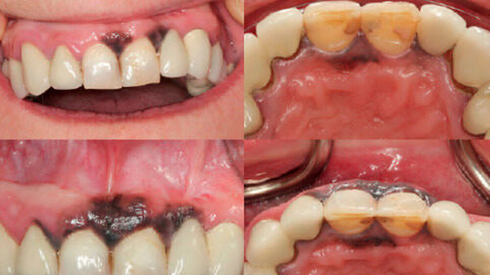 Abbildung 1: Intraorale Aufnahmen: schwärzliche Verfärbungen des Gingivasaumes in der Oberkieferfront vestibulär und palatinal der Oberkieferfrontzähne aus den Jahren 2007 (oben) und 2008 (unten)