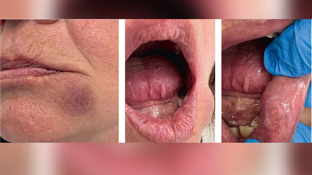 Abb. 1: Klinischer Befund an der Unterlippe linksseitig mit bläulich-lividem Aspekt von extra- und intraoral