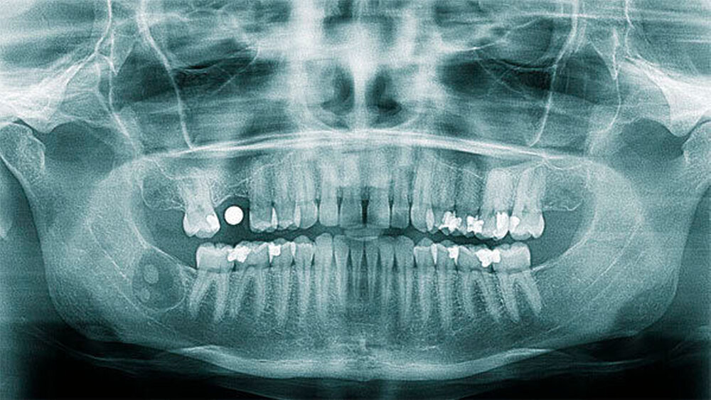 Abbildung 1 und 2: Präoperativer Befund im Orthopantomogramm mit Darstellung der Läsion in repräsentativer axialer Schicht. Erkennbar sind die mineralisierten Anteile sowie eine Auflösung der lingualen Lamelle. | Abbildung 1 und 2: Präoperativer Befund im Orthopantomogramm mit Darstellung der Läsion in repräsentativer axialer Schicht. Erkennbar sind die mineralisierten Anteile sowie eine Auflösung der lingualen Lamelle. |