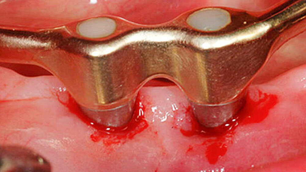 Abbildung 5: Auch bei korrekter Anwendung niedrigabrasiver Pulver- medien kann postoperativ eine leichte Blutung präsent sein. Hier sind bukkal der Implantate jedoch durch Fehlanwendung überproportional starke Gingivaschäden entstanden. |