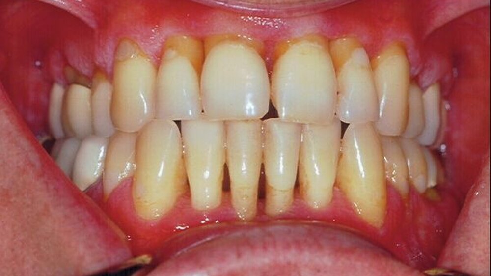 Abbildung 1: Chronische Parodontitis mit durchgemachten Schüben nekrotisierender ulzerierender Gingivitis/Parodontitis; Zustand sechs Monate nach konservierender Parodontitis-Therapie