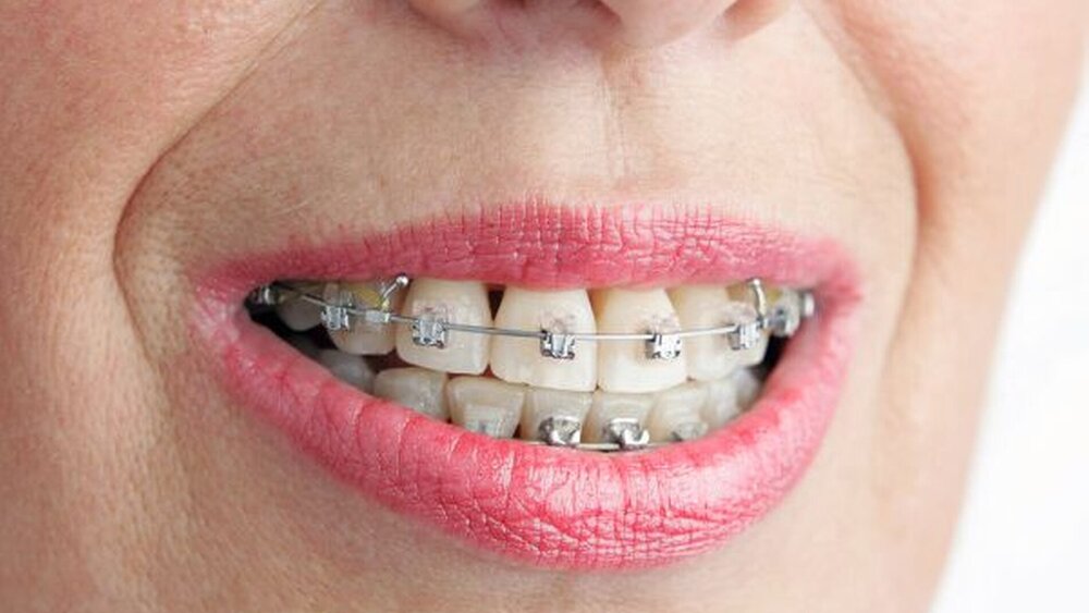 Neuerungen gibt es bei den Materialien, zum Beispiel bei den Brackets. |
