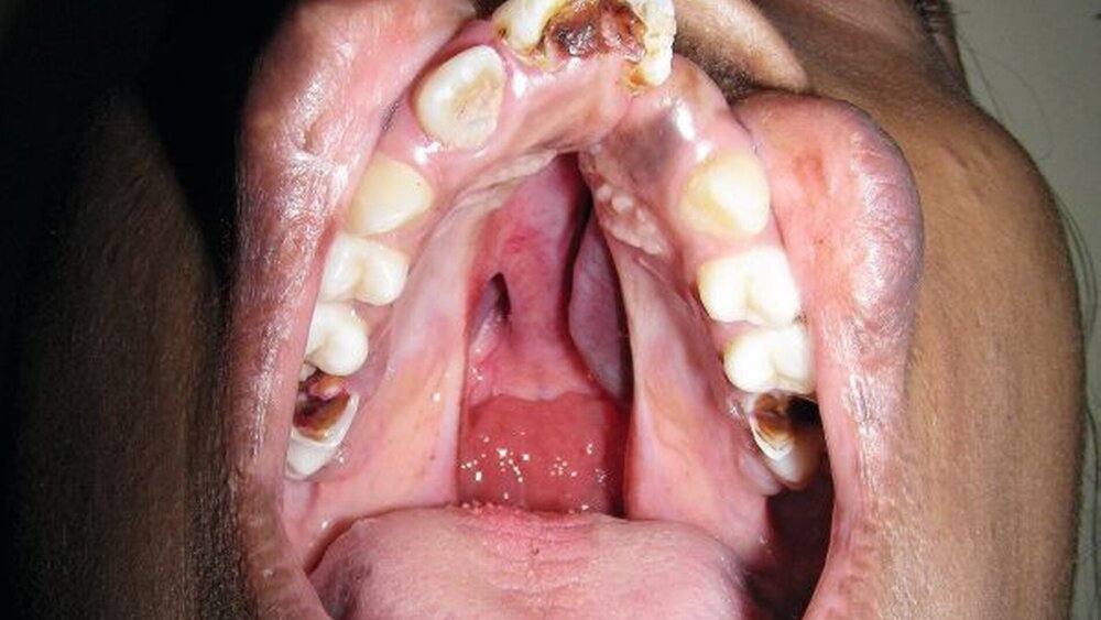 Abbildung 2: Bei der enoralen Untersuchung imponierte eine sich auf den harten und den weichen Gaumen ausdehnende Spalte. Der Nasenraum ist weit offen, der frontale Oberkiefer nach anterior verschoben. Die Zähne 11, 21, 16 und 26 sind kariös, ansonsten ist die Mundhygiene zufriedenstellend. |