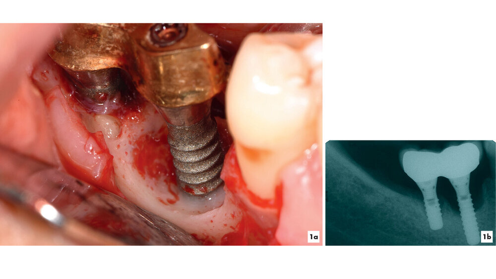 Abb. 1: Klinisches Bild einer Periimplantitis inklusive Röntgenbild