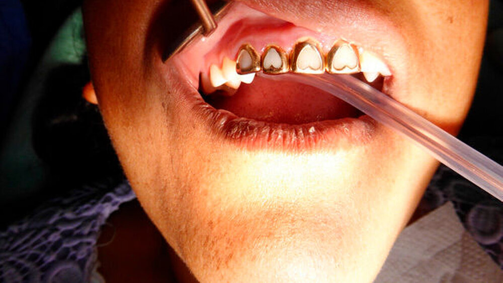 Wer in Bolivien etwas wohlhabender ist, zeigt es auch in Form von goldenem Zahnschmuck – herzförmig labial offene „Fensterkronen“. Solche Kronen wurden auch in Deutschland in den 50er Jahren vom Berufsstand der Dentisten eingegliedert. |
