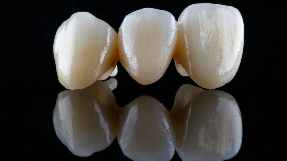 Erfragt wird auch die durch den Zahnarzt üblicherweise verwendete Technik beziehungsweise das üblicherweise verwendete Material für die Reparatur eines intraoralen Chippings im verblendkeramischen Bereich.
