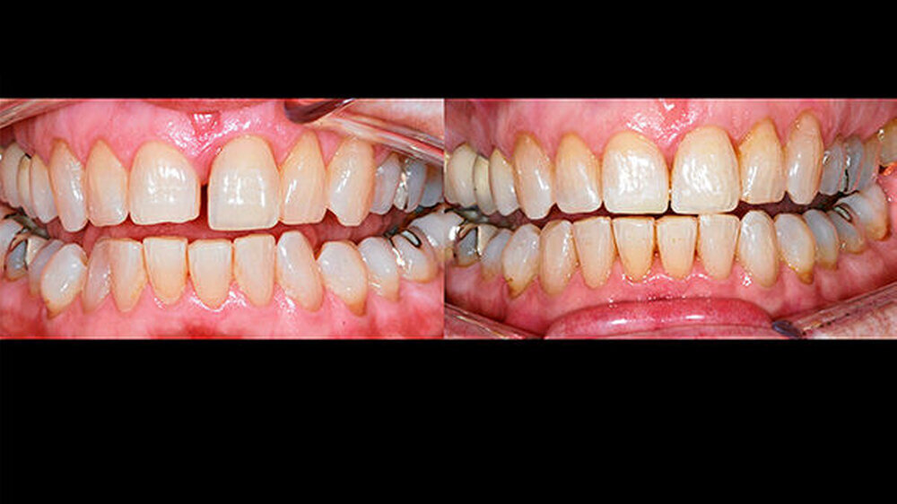 Fall einer älteren Patientin mit protrudiertem Frontzahn 21 und extrudierter Unterkiefer-Front. Links Ausgangssituation, rechts Situation nach Abschluss der Invisalign-Therapie