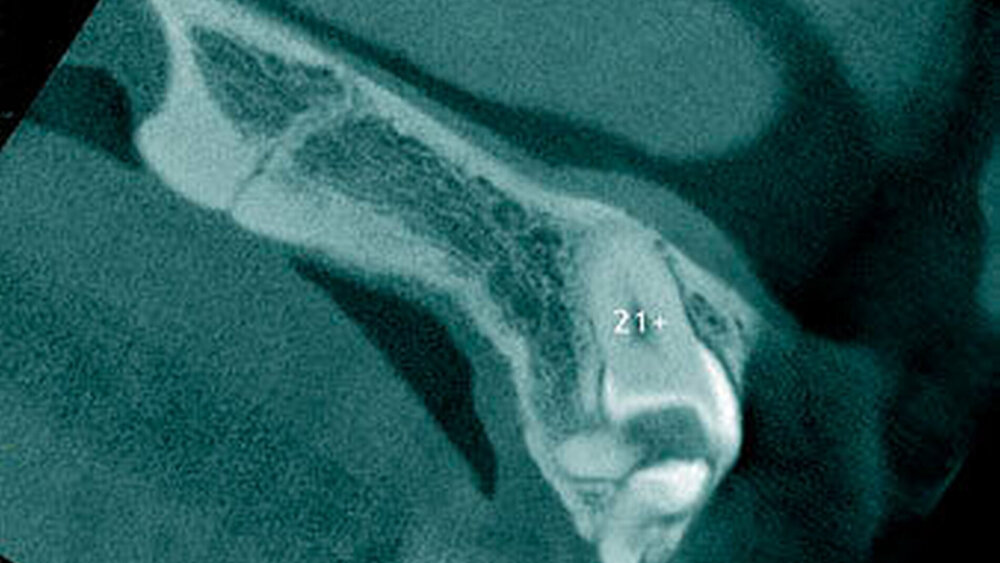 Abbildung 12: Überzähliger Zahn im Oberkieferfrontbereich (21+) mit einer konischen Form sowie ein zusammengesetztes Odontom disto-kaudal dieses überzähligen Zahnes bei einem 14-jährigen Knaben  (b: sagittaler Schnitt) |