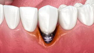 Peri-implantitis with visible gingiva recession. Medically accurate 3D illustration.