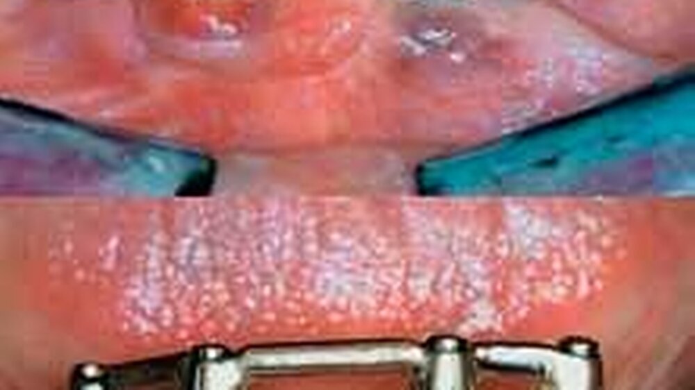 Entzündung der Implantate bei falscher Mundhygiene (oben).\r\nImplantate nach Instruktion zur Mundhygiene – der Therapieerfolg (unten).