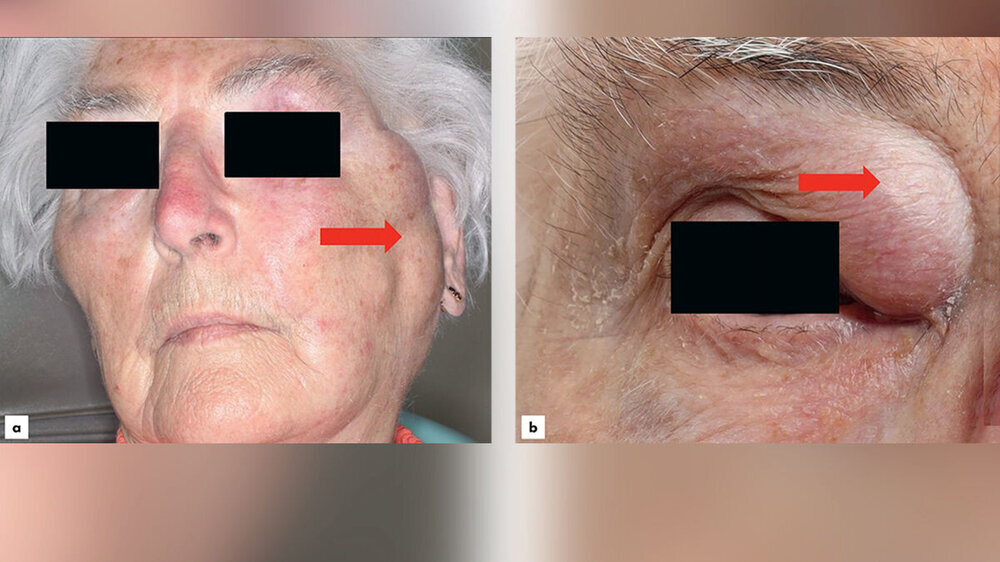 Abb. 1: Klinische Bilder der 90-jährigen Patientin mit unklarer Weichgewebsveränderung im Bereich der Wange links (a) sowie im Bereich des Oberlids rechts (b) bei Erstvorstellung