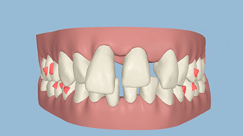 Abbildung 3: Die Ausgangssituation im Clinical Check von Invisalign, a: frontal Abbildung 3: Die Ausgangssituation im Clinical Check von Invisalign, a: frontal