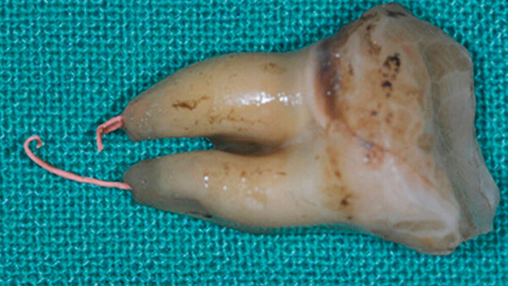 Abbildung 5: Entfernter Zahn 47 mit überpresstem Wurzelfüllmaterial |