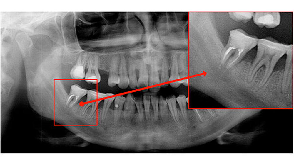 Abbildung 2: Präoperativer Befund im Orthopanthomogramm |