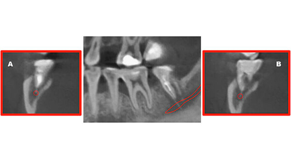 Abbildung 4: DVT-Aufnahme mit Nervverlauf (mittig), A – mesiale Wurzel Zahn 47, B – distale Wurzel Zahn 47: Bei beiden Wurzeln besteht direkter Kontakt mit dem Nervus alveolaris inferior. |