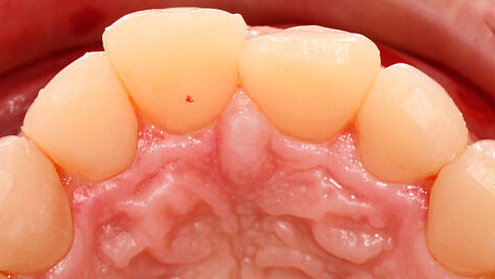 Abbildung 5: Aufbau der palatinalen Zahnhartsubstanzverluste im Oberkiefer-Frontzahnbereich mit Komposit, vor Modellherstellung und Aufwachsen der Oberkieferfrontzähne |