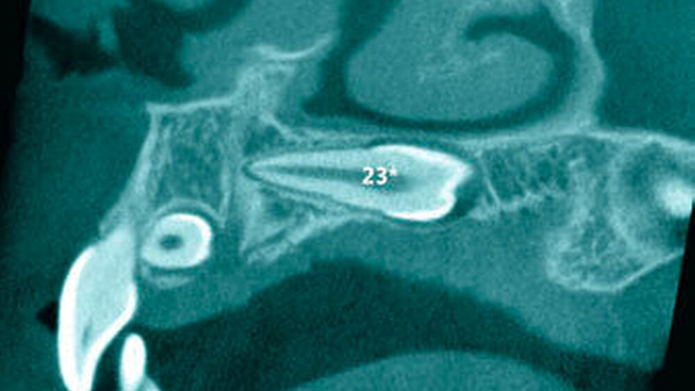 3f: Sagittalschnitt mit Darstellung von 23+. |