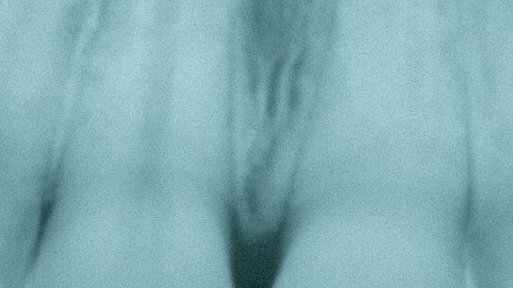 Abbildungen: Beispiele für Pulpaobliterationen infolge von Traumata, Zustand nach Subluxation.