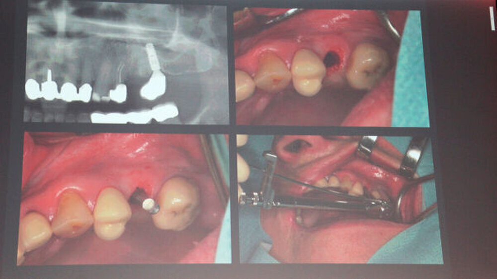 Wann ist die Sofortversorgung von Implantaten eine sichere Behandlungsoption? Diese Frage beleuchtete Prof. Dr. Georg-Hubertus Nentwig, Direktor der Poliklinik für Zahnärztiche Chirurgie und Implantologie der Universität Frankfurt, in seinem Vortrag.