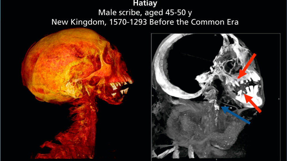 CT-Aufnahmen von Hatiay, einer Mumie mit Anzeichen sowohl von Karotisverkalkungen (blauer Pfeil) als auch von schlechter Zahngesundheit (rote Pfeile).