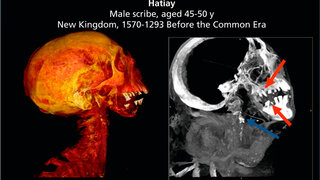 CT-Aufnahmen von Hatiay, einer Mumie mit Anzeichen sowohl von Karotisverkalkungen (blauer Pfeil) als auch von schlechter Zahngesundheit (rote Pfeile).
